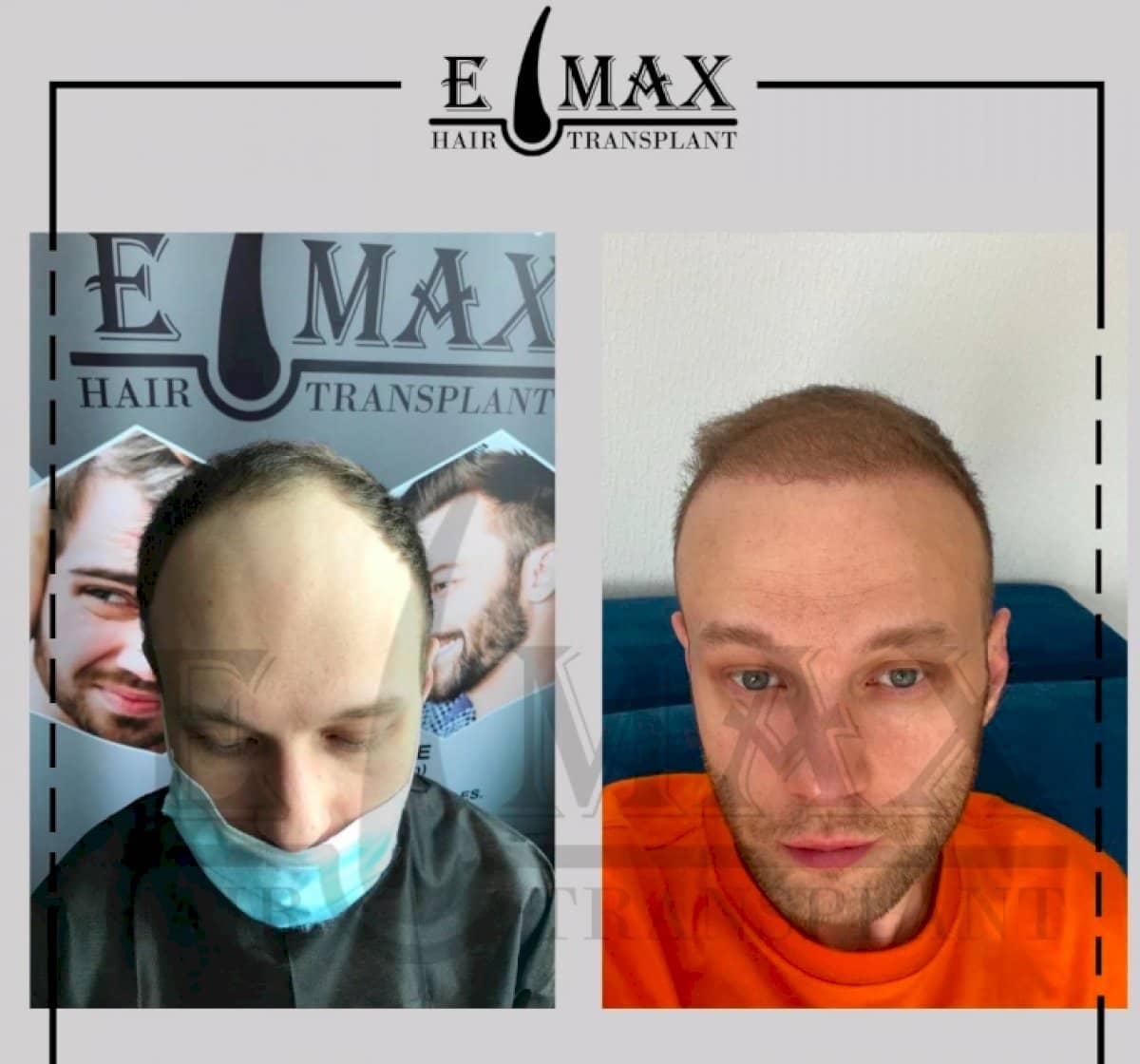 Case 20762 - FUE hair transplant