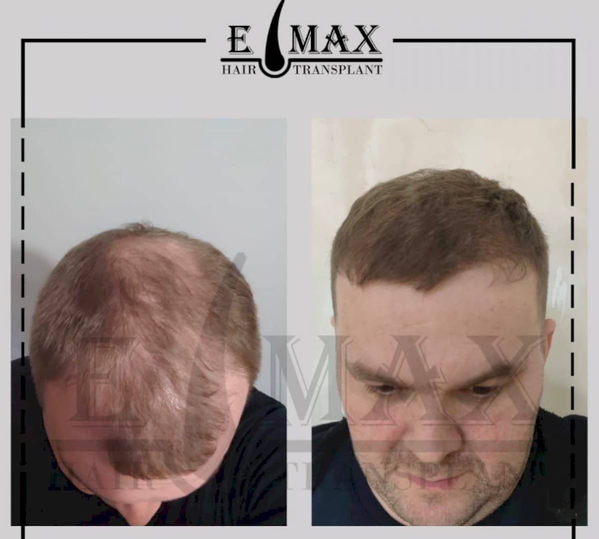 Case 20763 - hair transplant