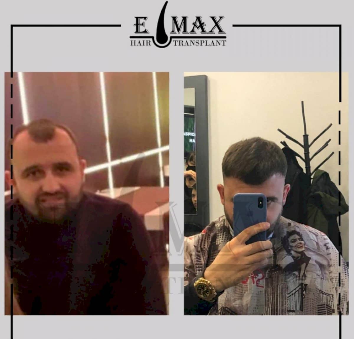Case 20764 - FUE hair transplant
