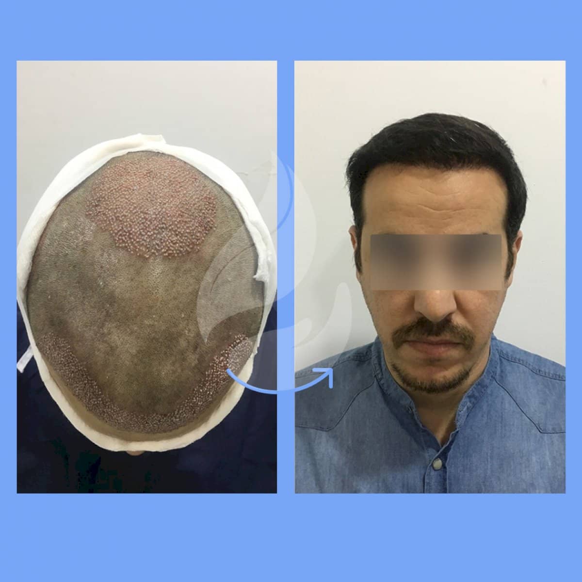 Case 20796 - FUE hair transplant