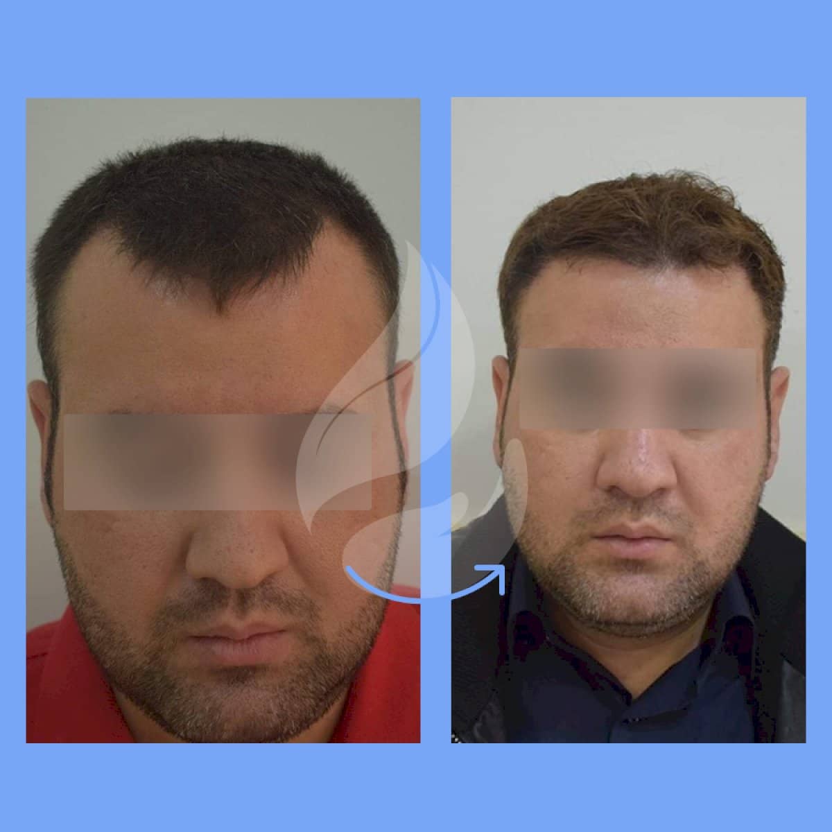 Case 20798 - DHI hair transplant