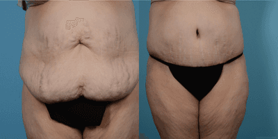 Case 2081 - 55-64 year old woman treated with Tummy Tuck