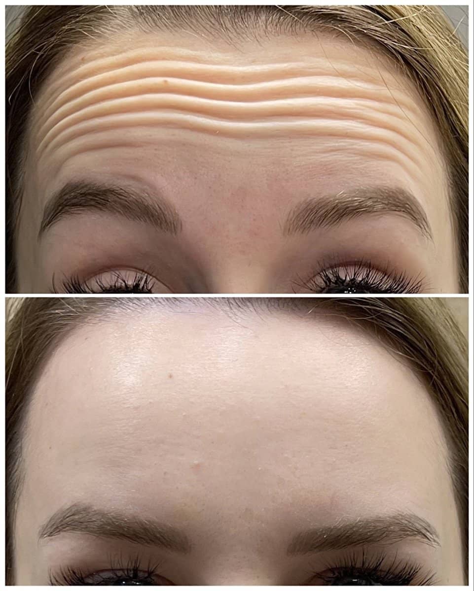 Case 20839 - Botox injections