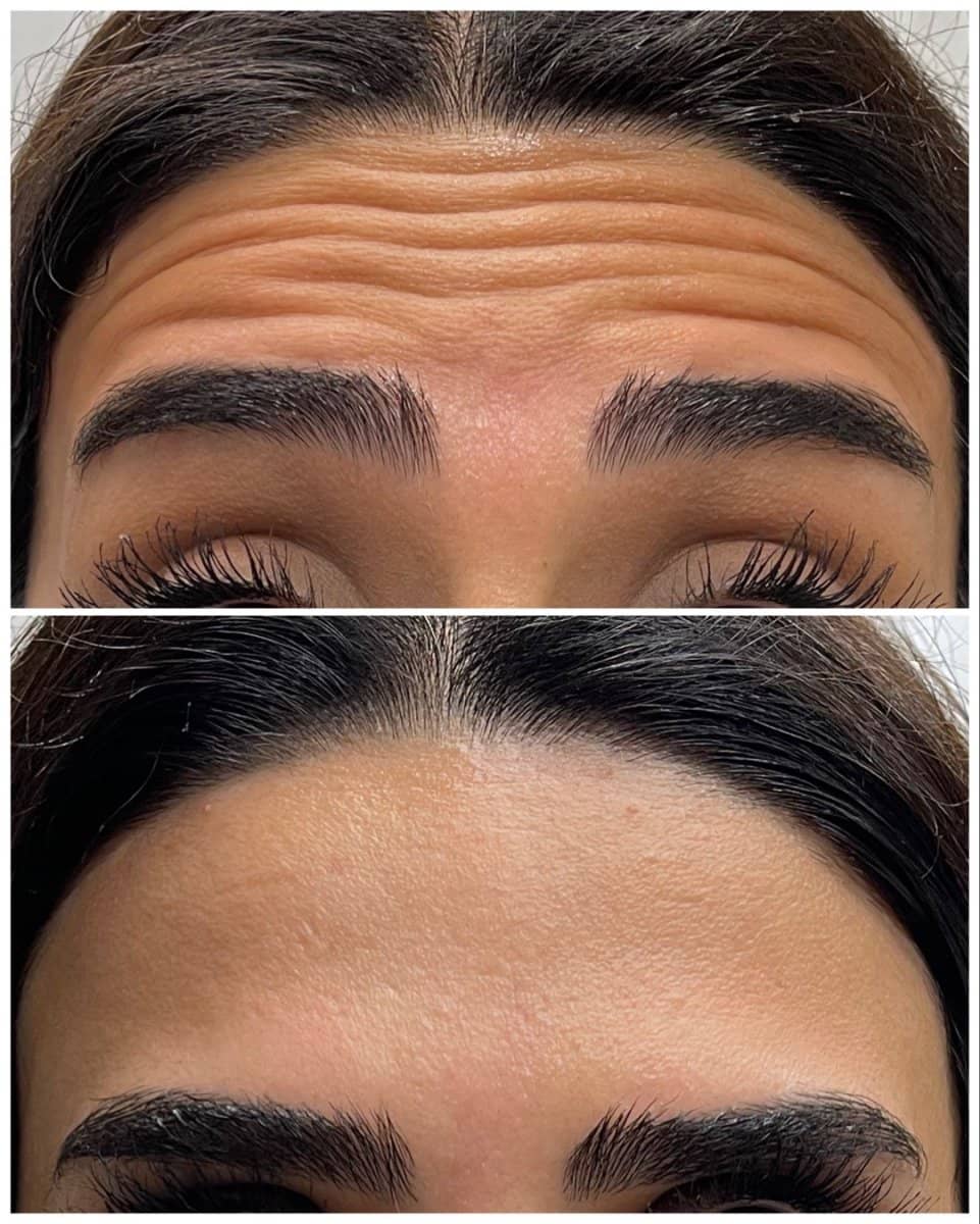 Case 20840 - Botox injections