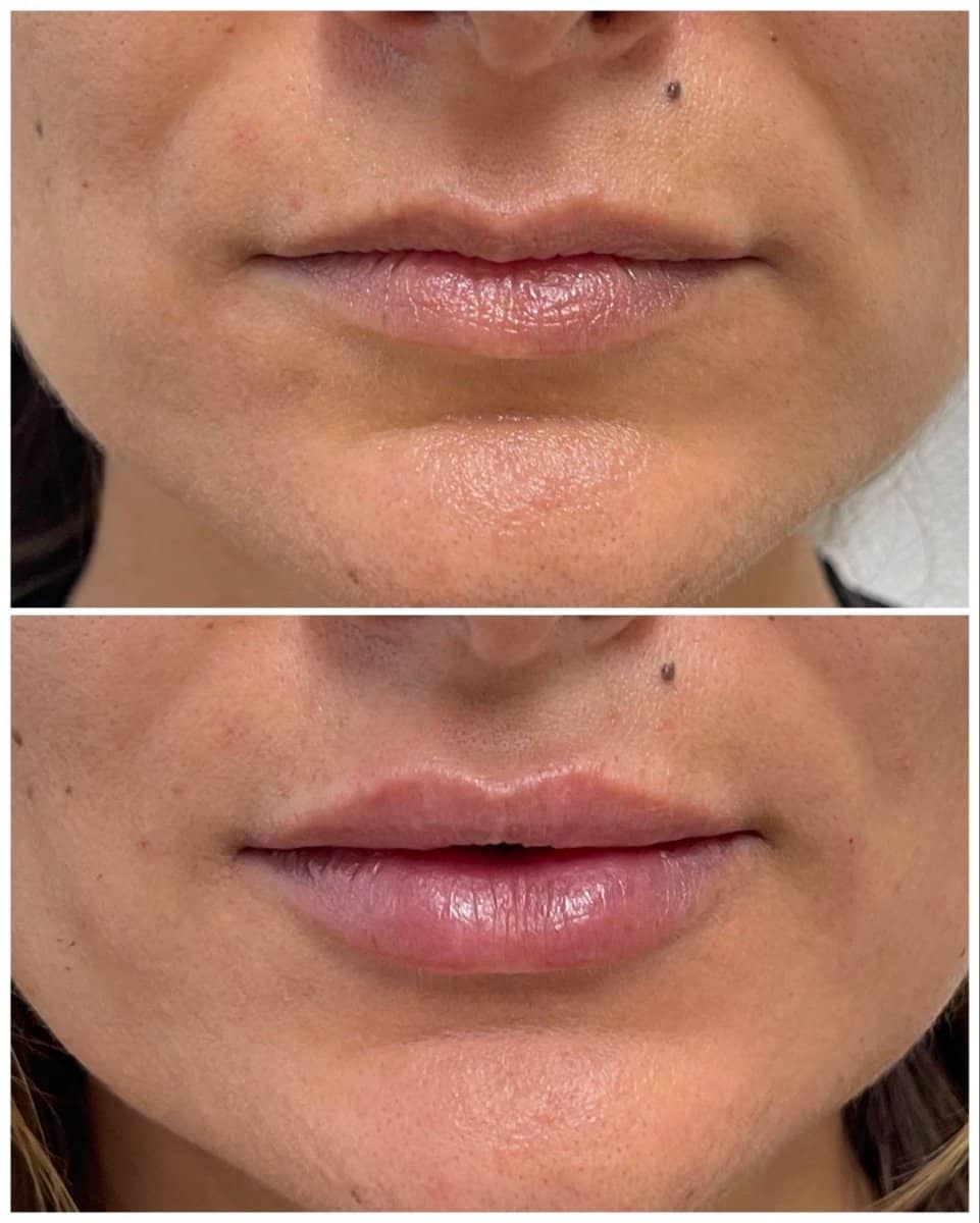 Case 20841 - fillers injection