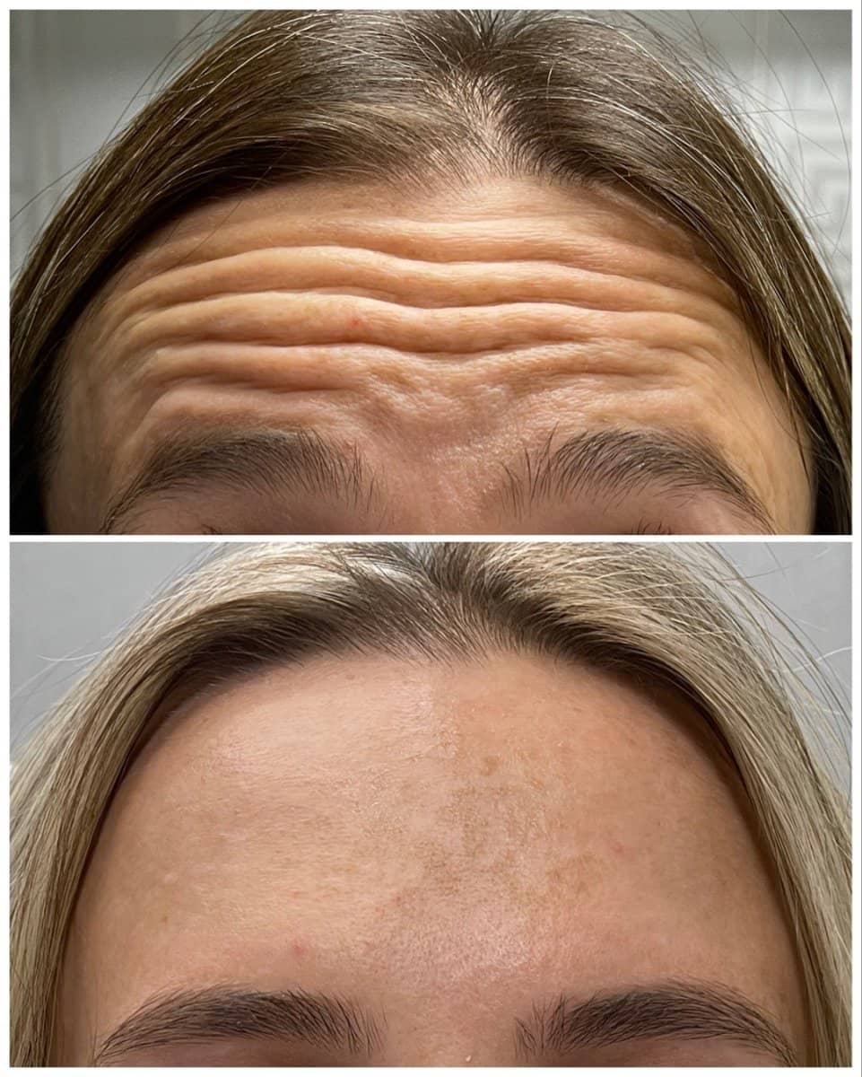 Case 20842 - Botox injections
