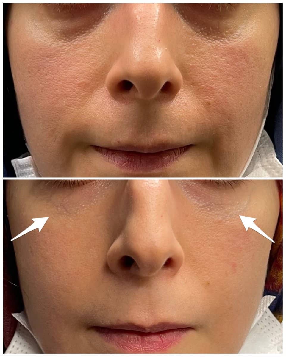 Case 20843 - fillers injection