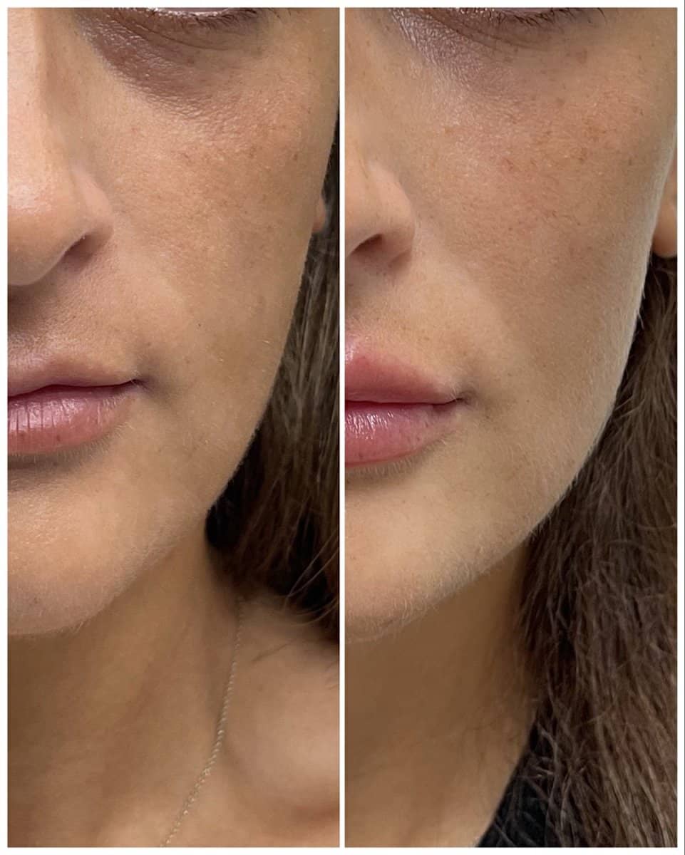 Case 20844 - fillers injection