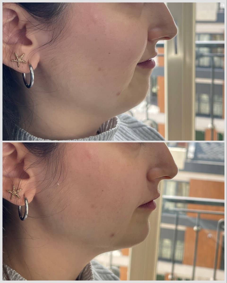 Case 20845 - fillers injection
