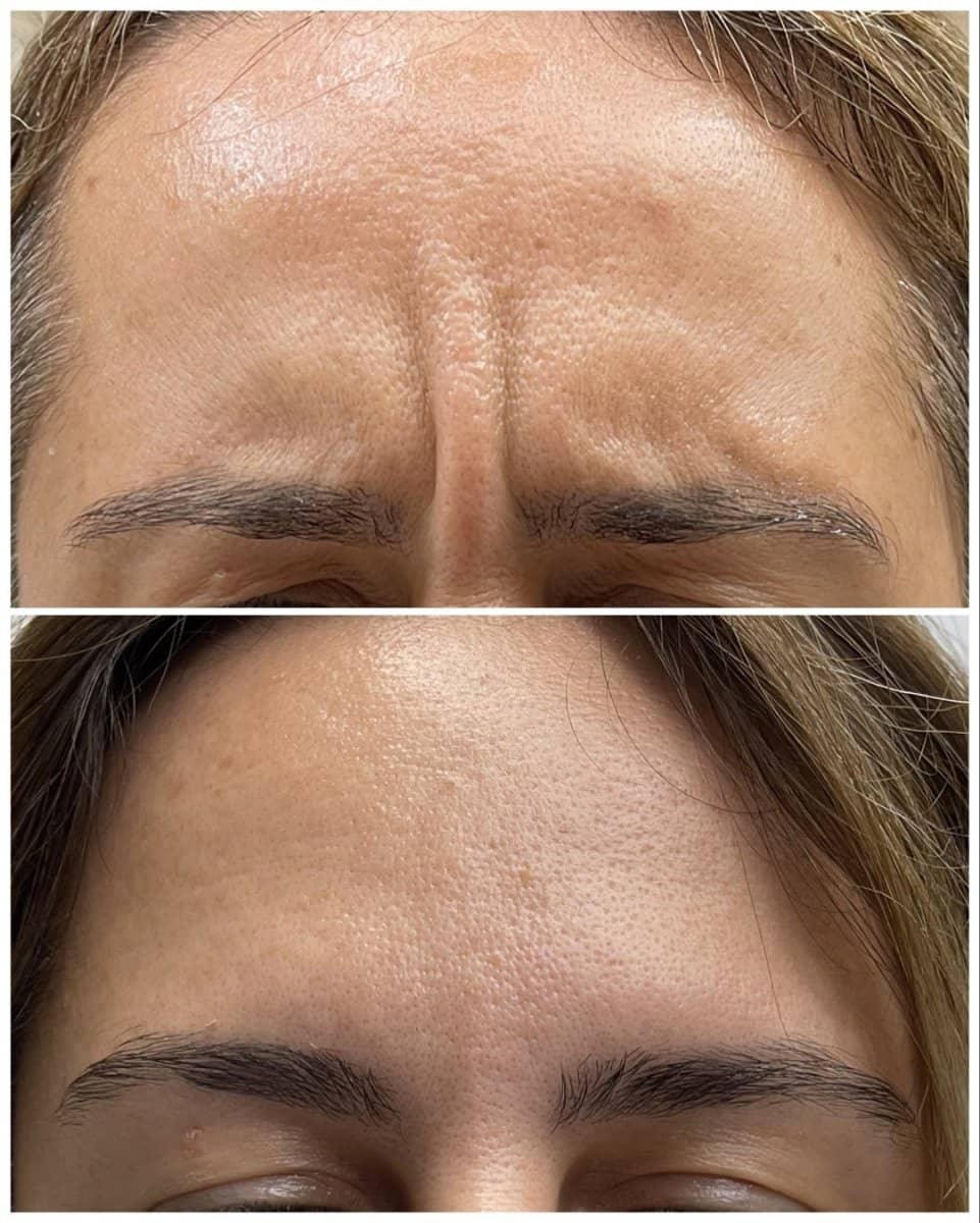 Case 20847 - Botox injections