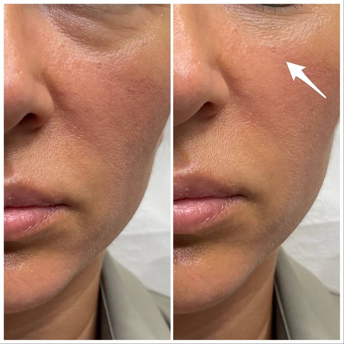Case 20850 - fillers injection