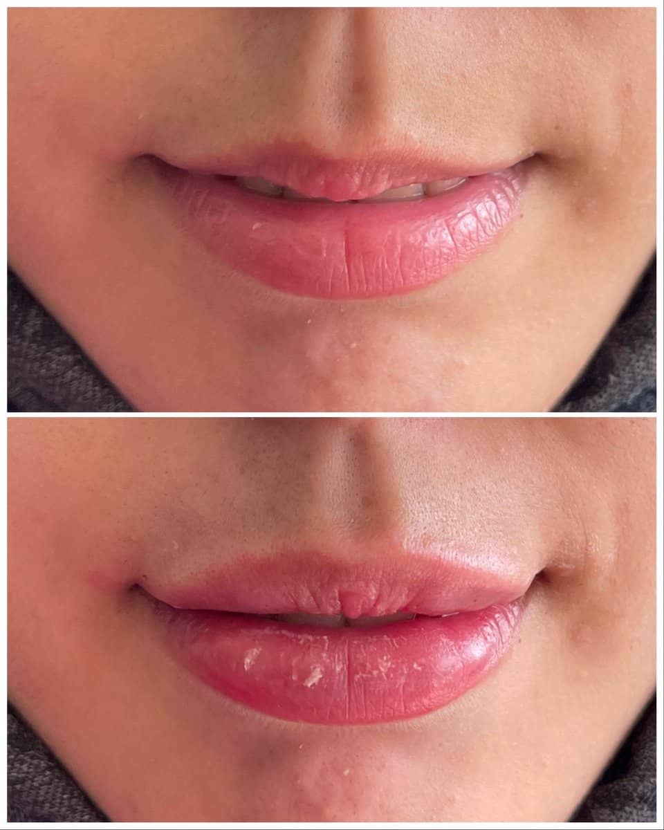 Case 20853 - lip fillers injection