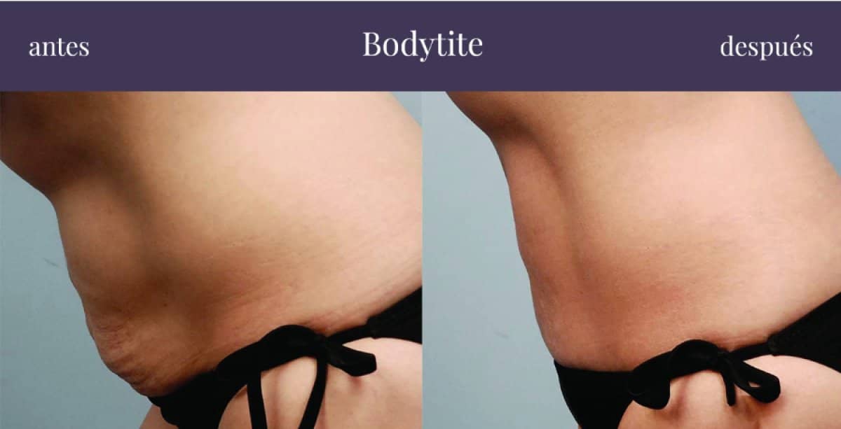 Case 20856 - BodyTite liposuction