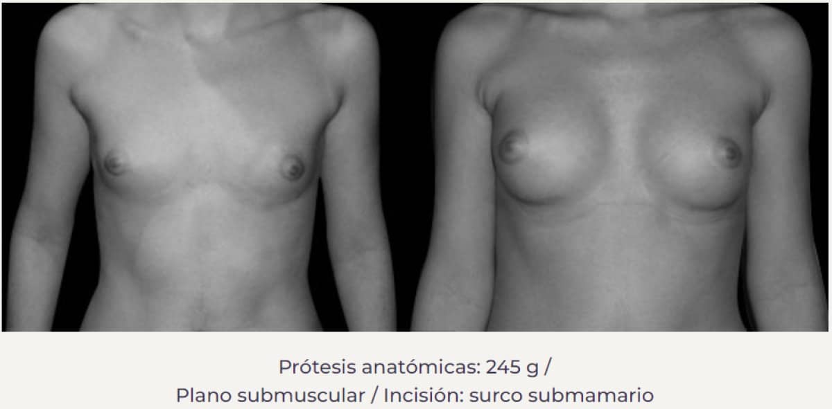 Case 20857 - breast augmentation