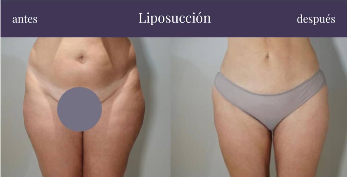 Case 20859 - liposuction