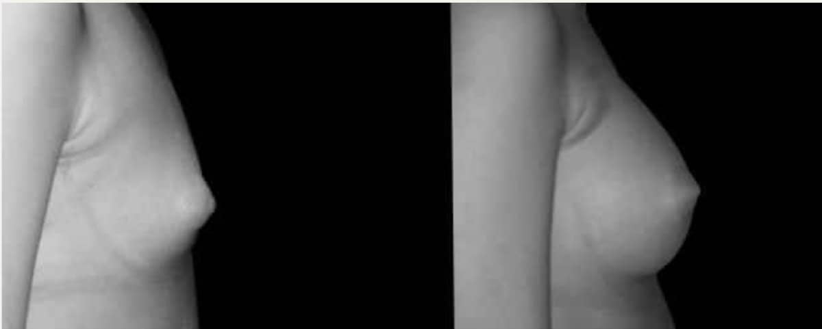 Case 20860 - breast augmentation