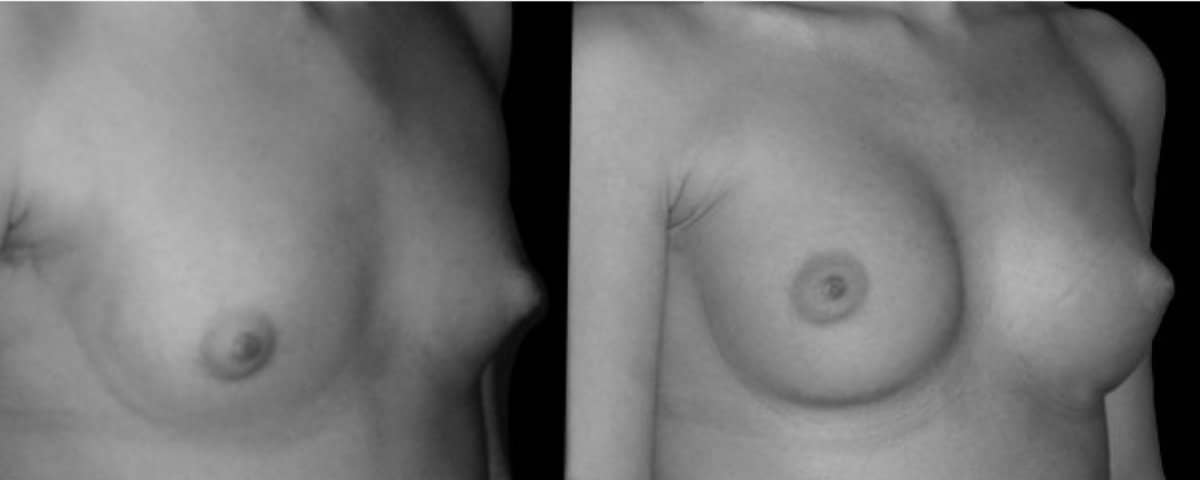 Case 20861 - breast augmentation