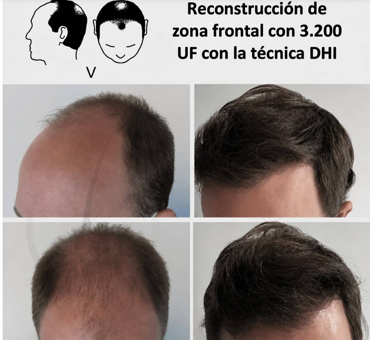 Case 20862 - DHI hair transplant