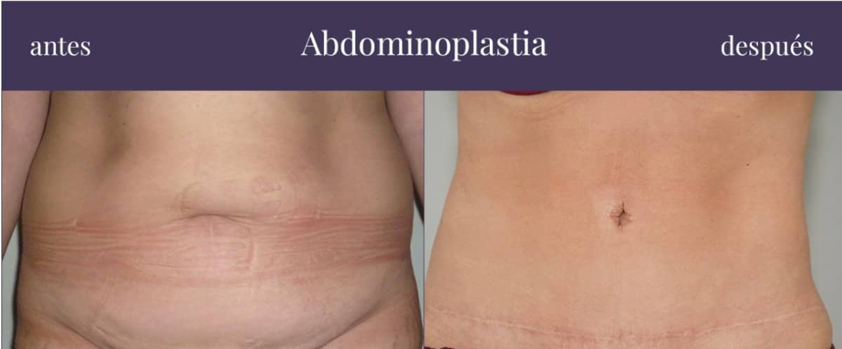 Case 20864 - tummy tuck