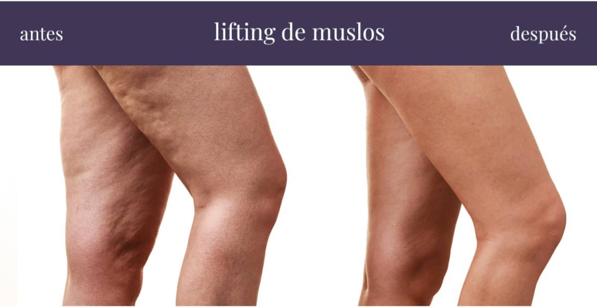 Case 20866 - thigh lift