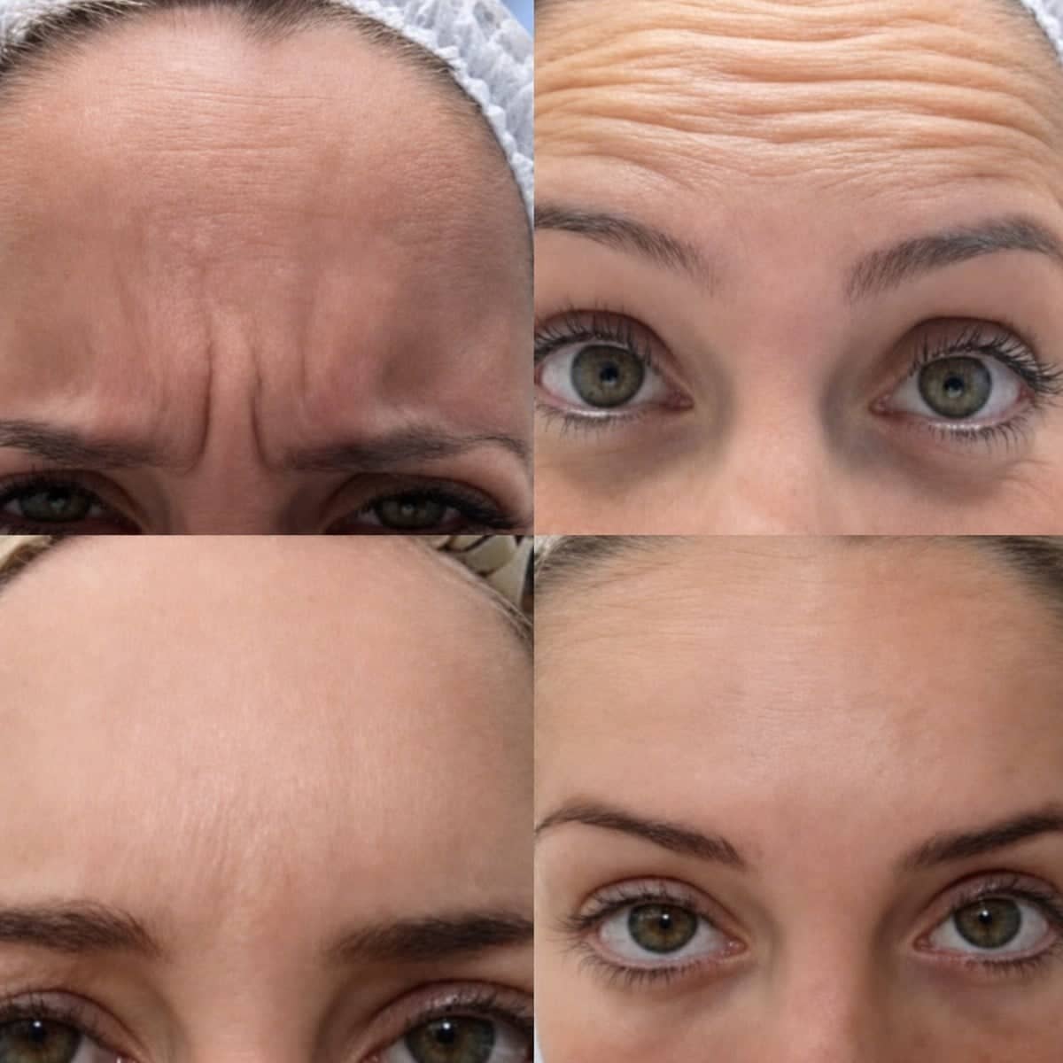 Case 20912 - Botox injections