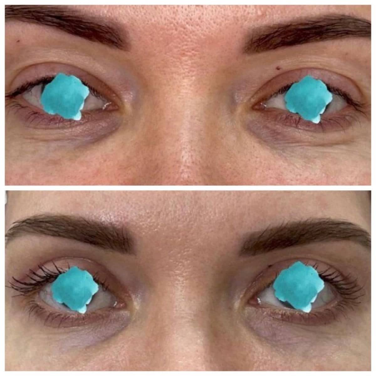 Case 20913 - lower eyelid blepharoplasty
