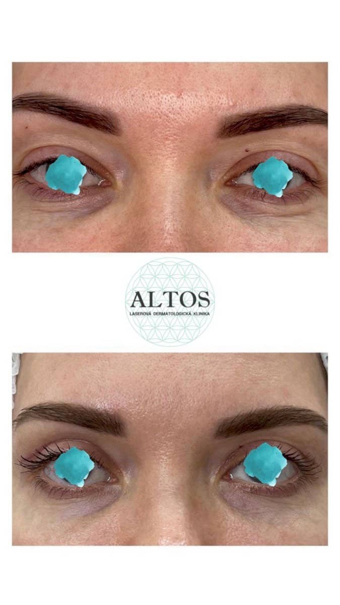 Case 20914 - blepharoplasty
