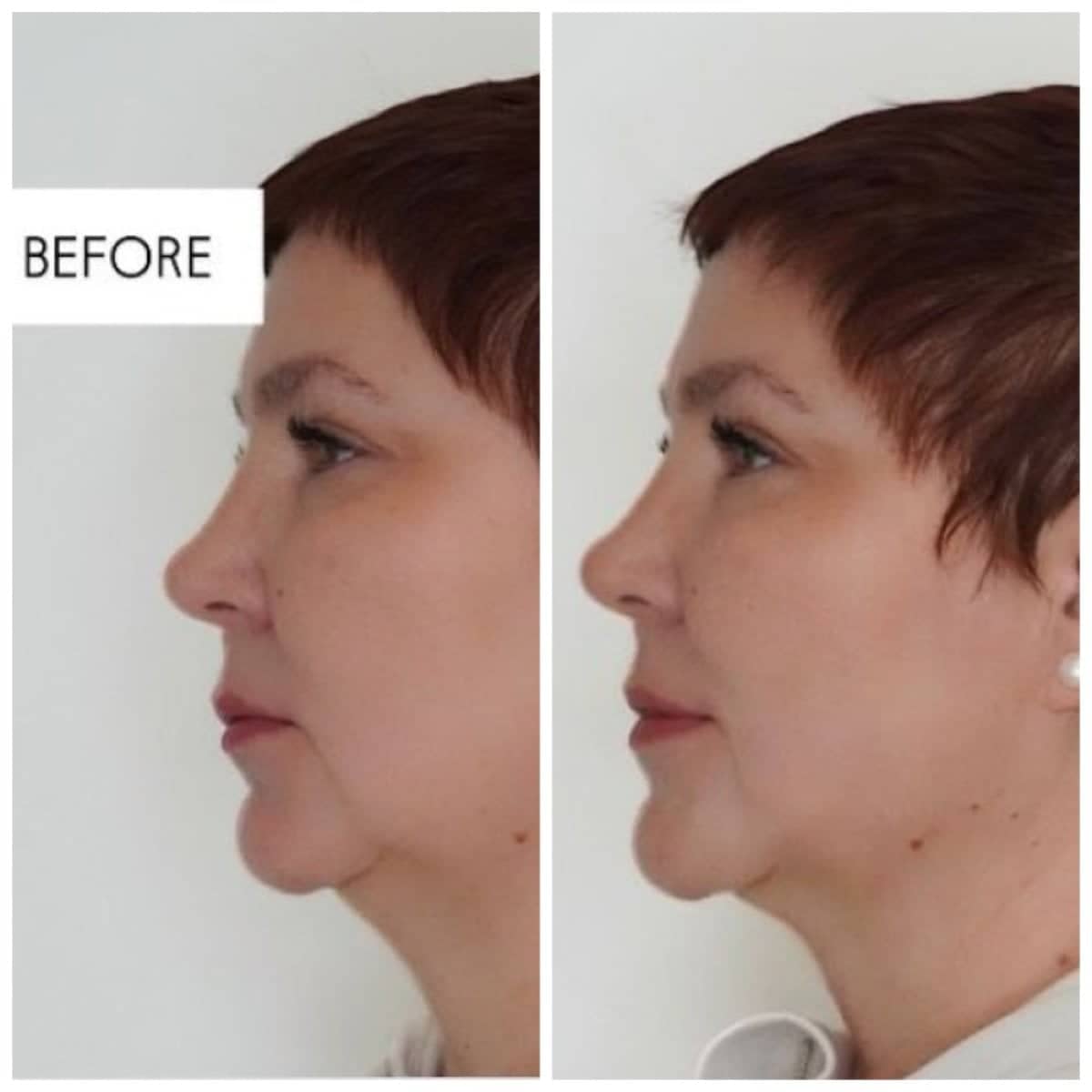 Case 20915 - nonsurgical facelift