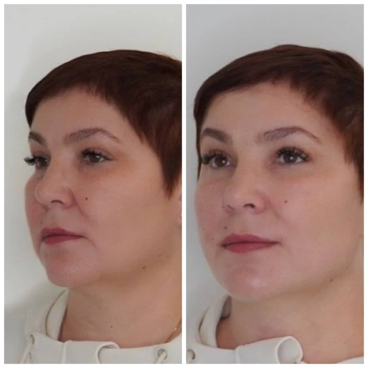 Case 20916 - nonsurgical facelift