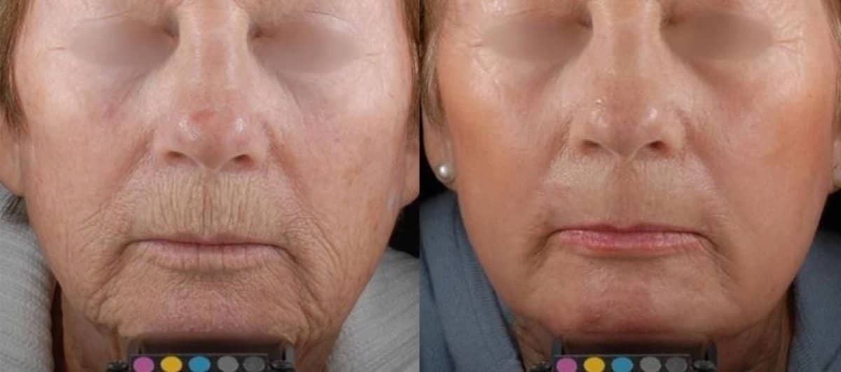 Case 20917 - laser skin resurfacing