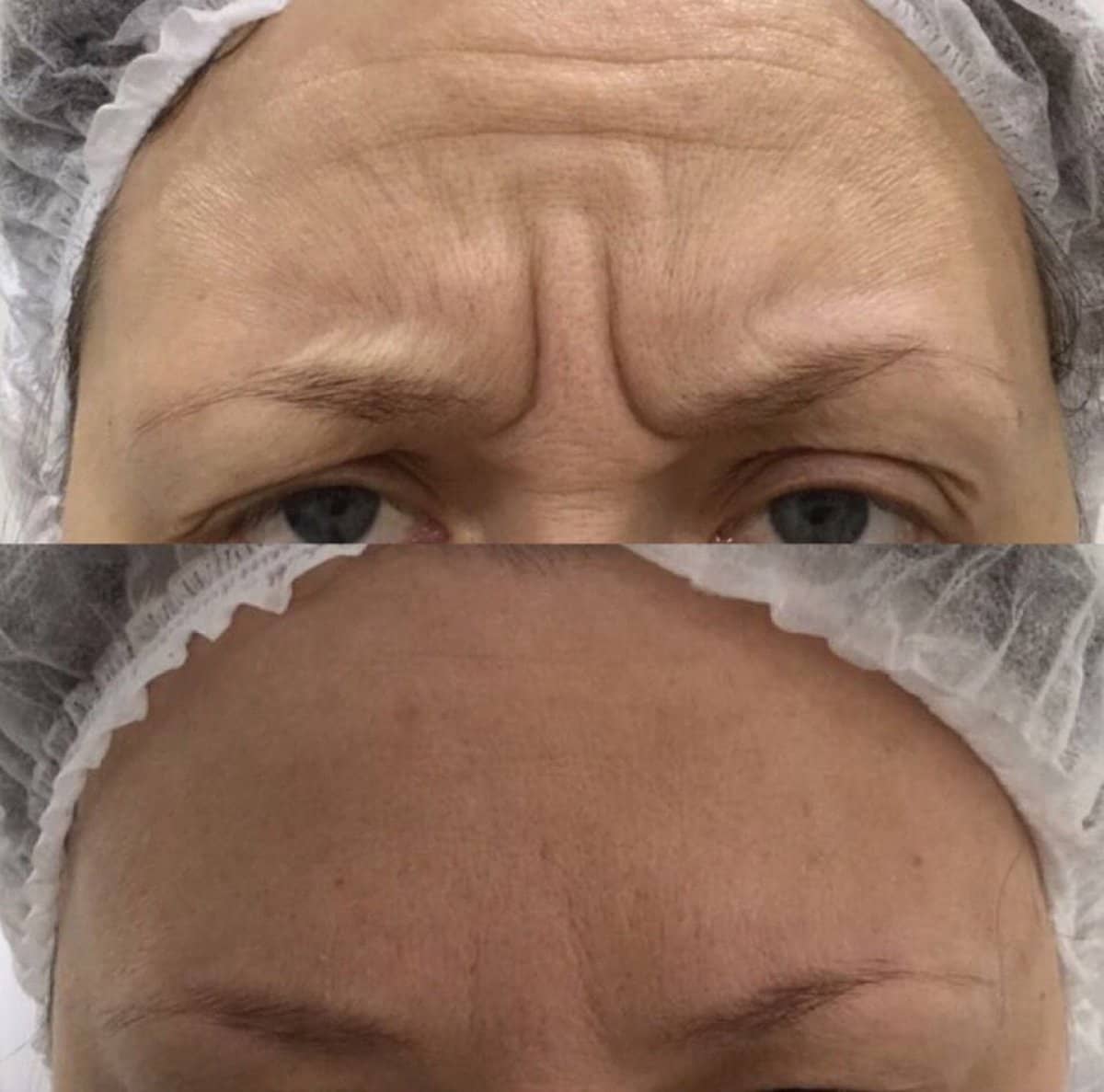 Case 20919 - Botox injections