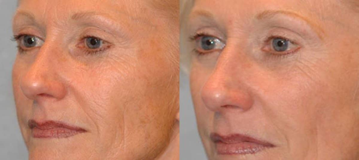 Case 20920 - fillers injection