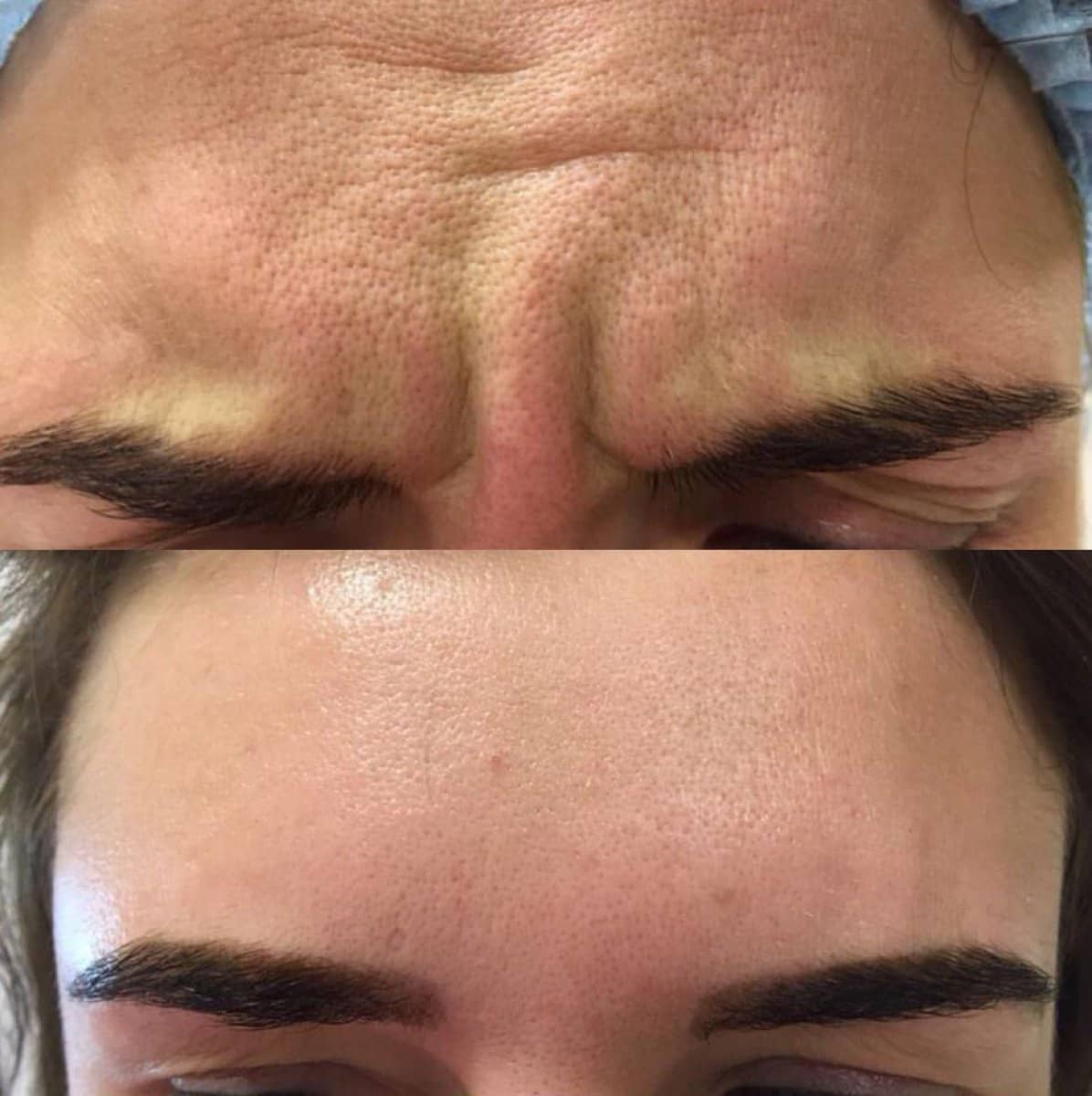 Case 20921 - Botox injections