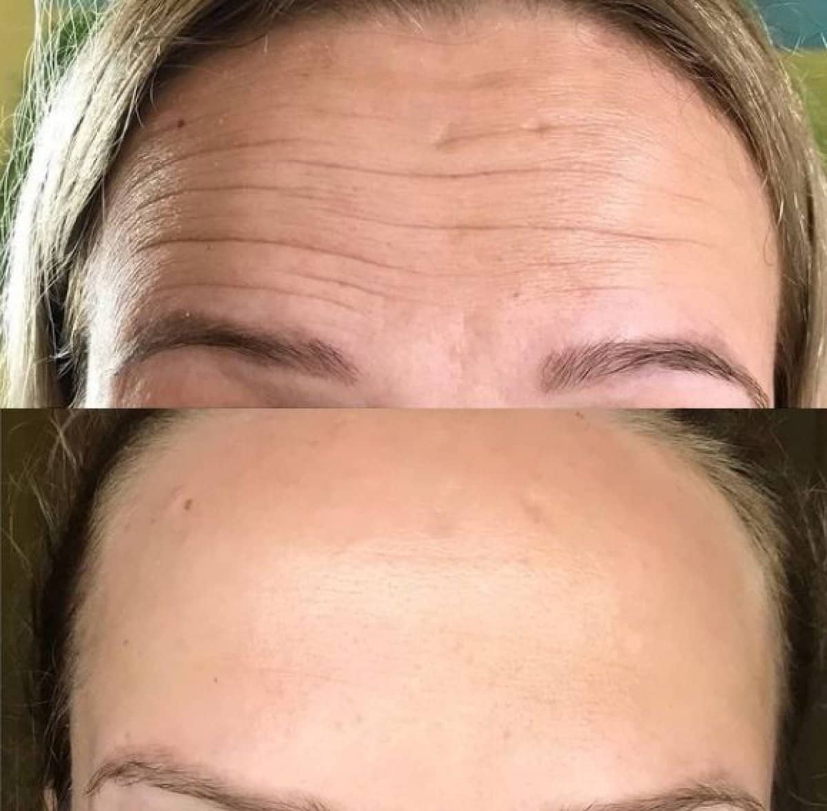 Case 20922 - Botox injections