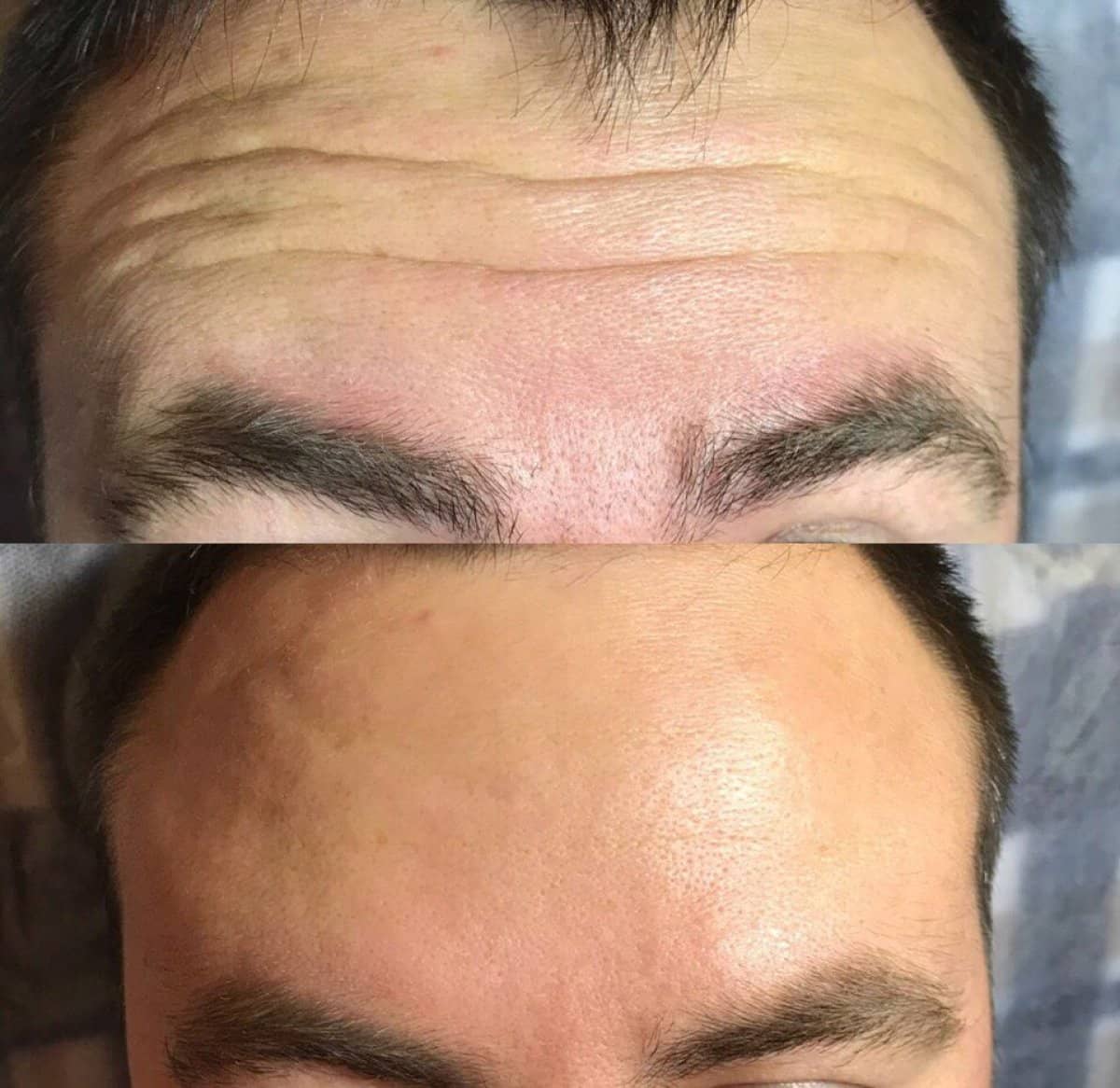 Case 20923 - Botox injections