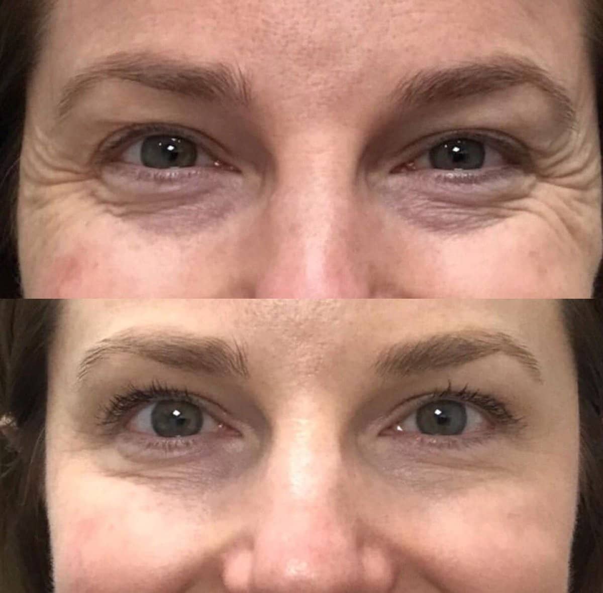 Case 20924 - Botox injections