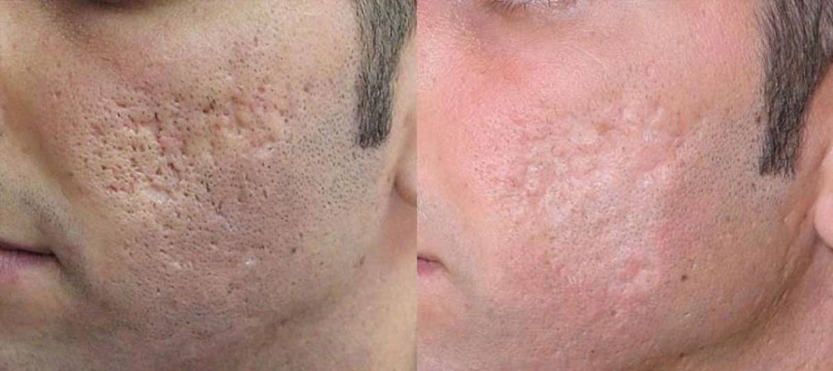 Case 20925 - laser skin resurfacing