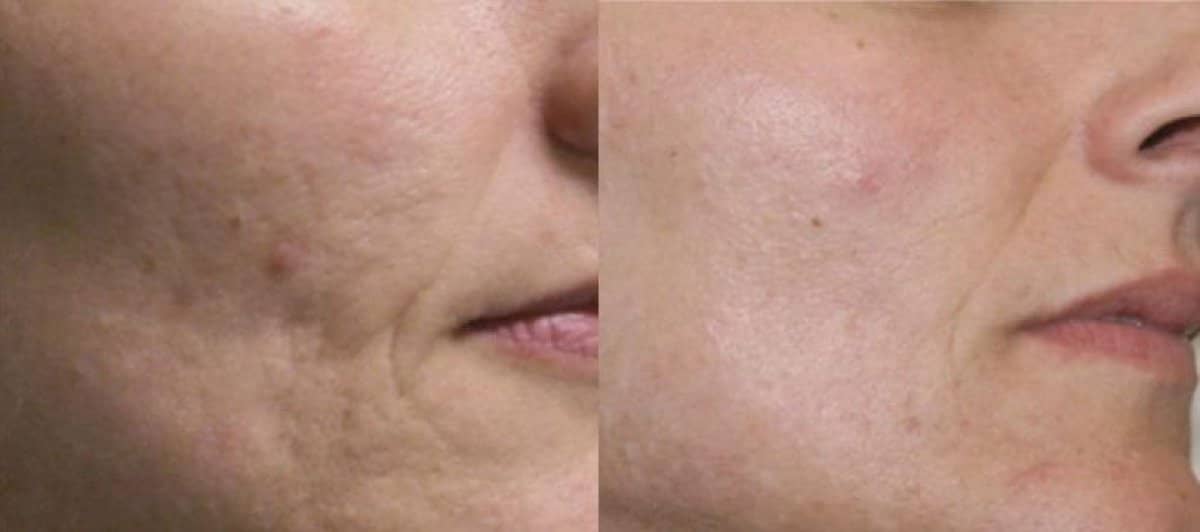 Case 20928 - laser skin resurfacing