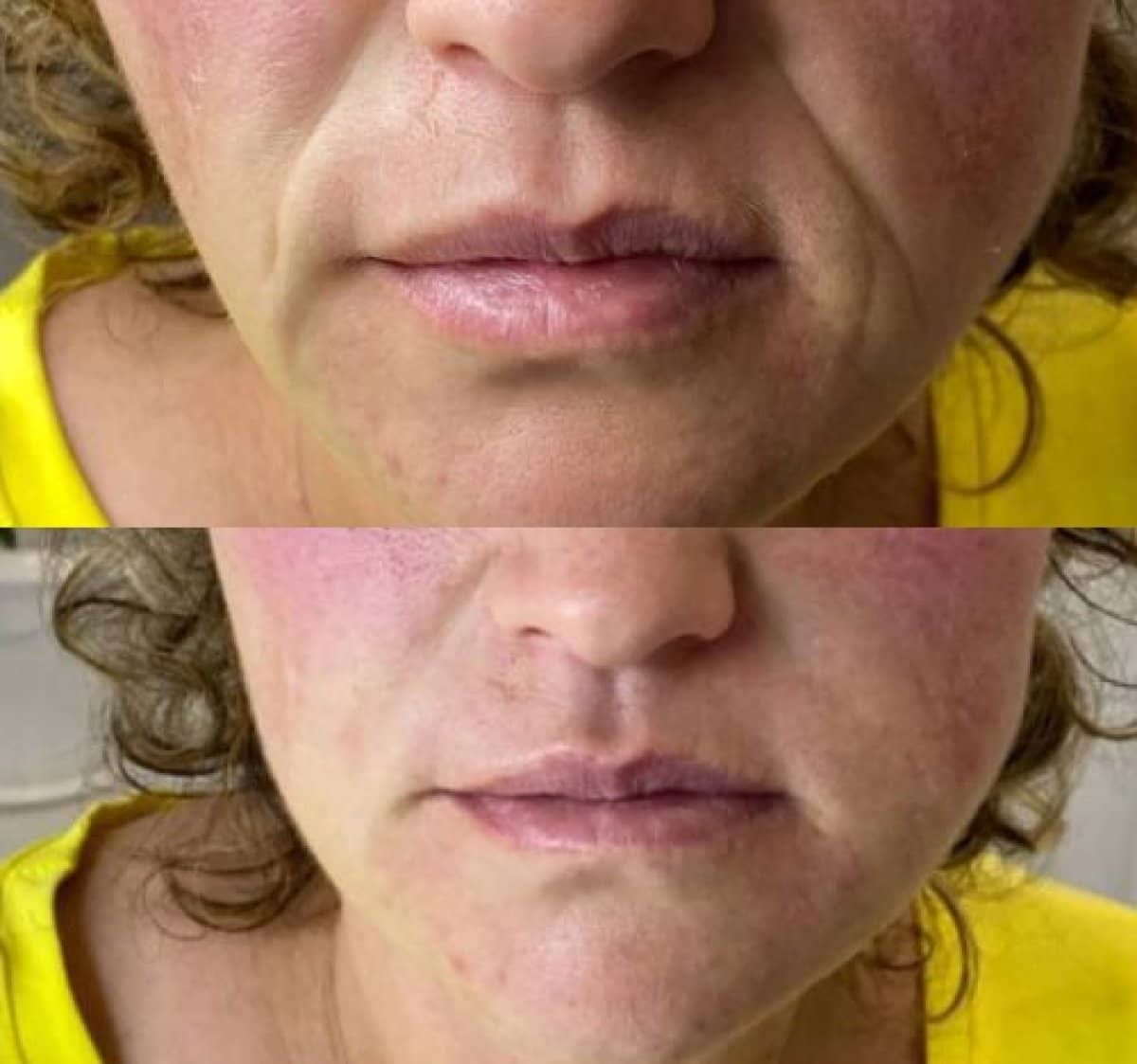 Case 20929 - Botox injections