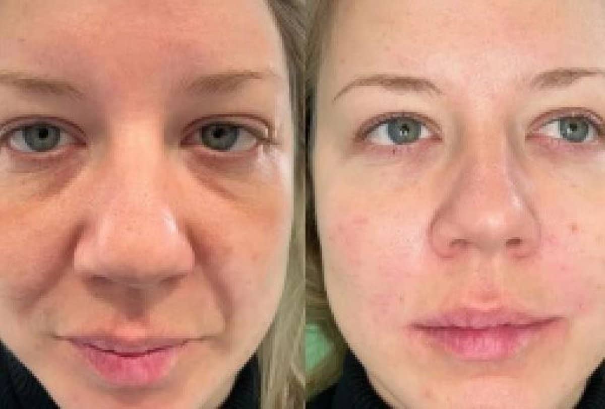 Case 20932 - Botox injections
