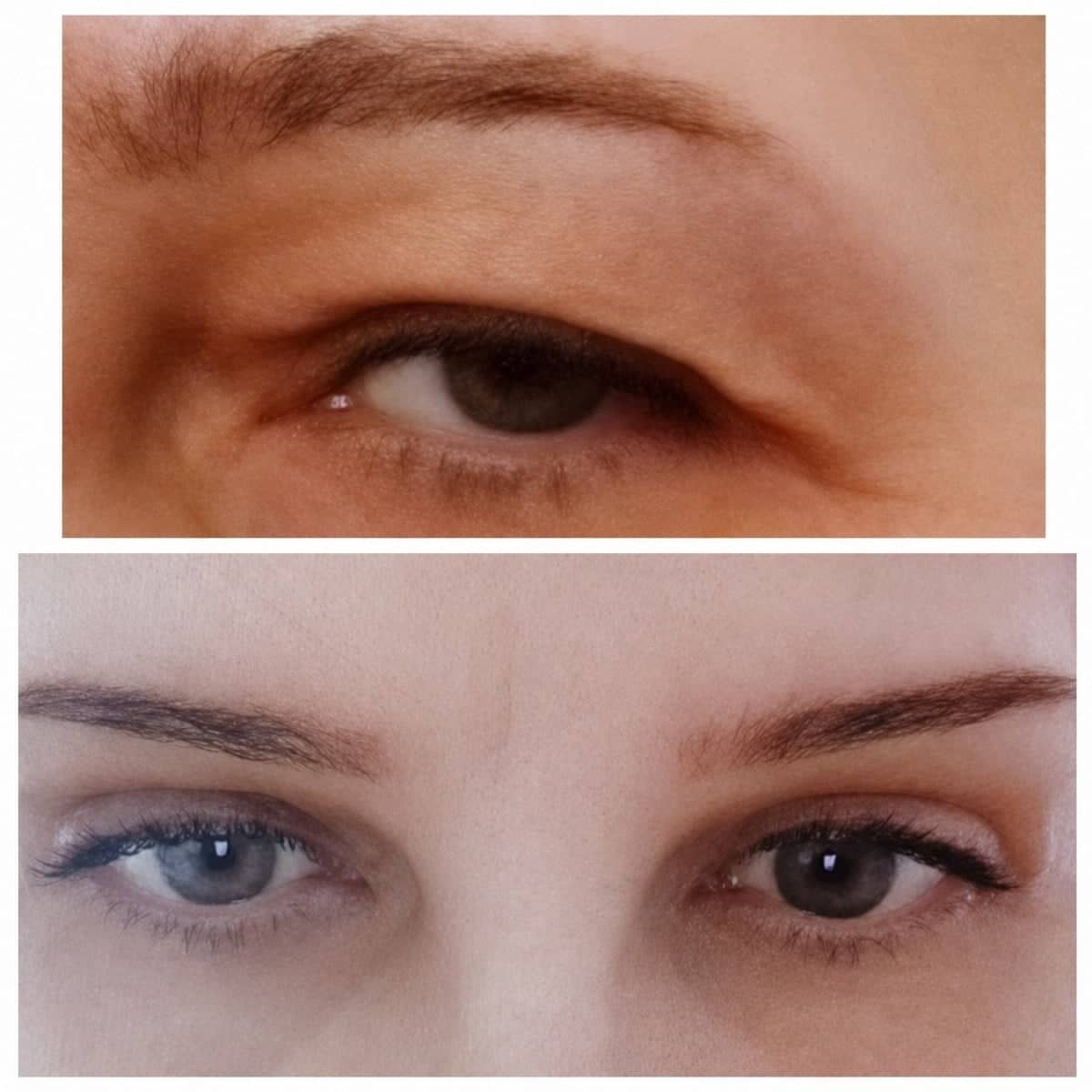 Case 20933 - blepharoplasty