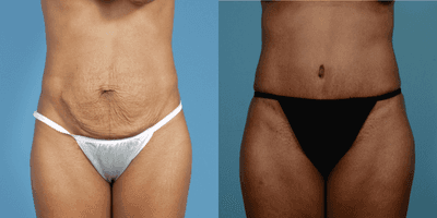 Case 2095 - 45-54 year old woman treated with Tummy Tuck for Mommy Makeover