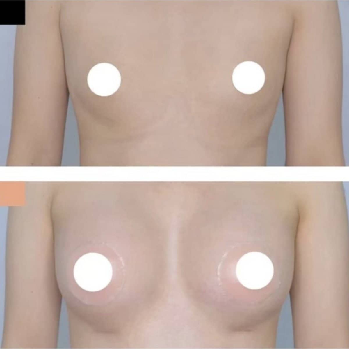 Case 20984 - breast augmentation