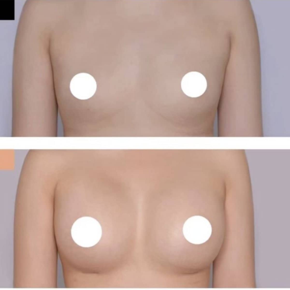 Case 20985 - breast augmentation