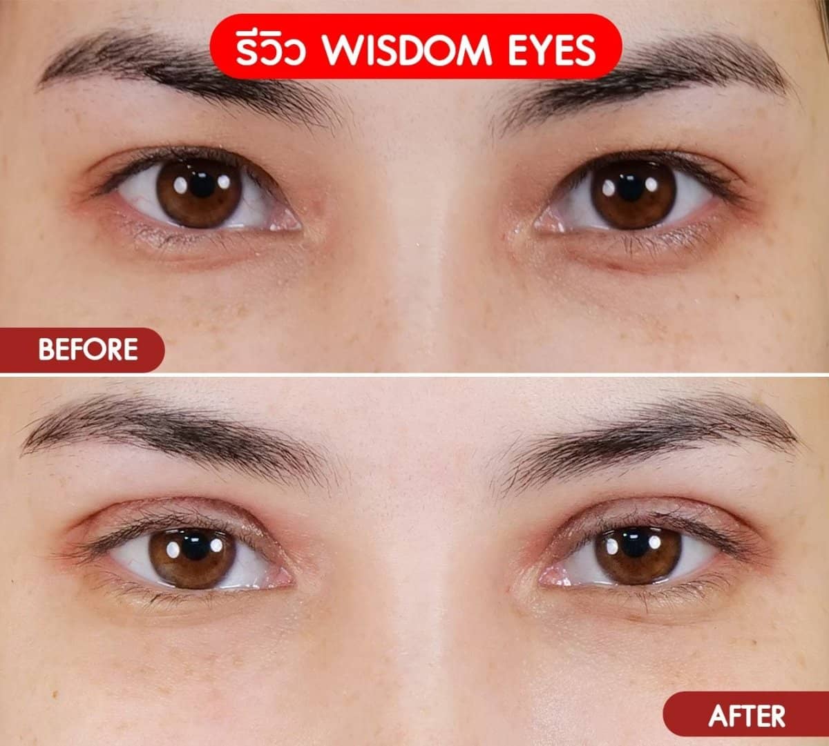 Case 20986 - double eyelid surgery