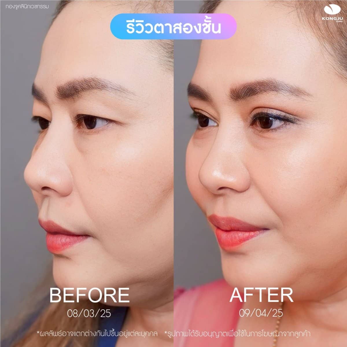 Case 20988 - double eyelid surgery
