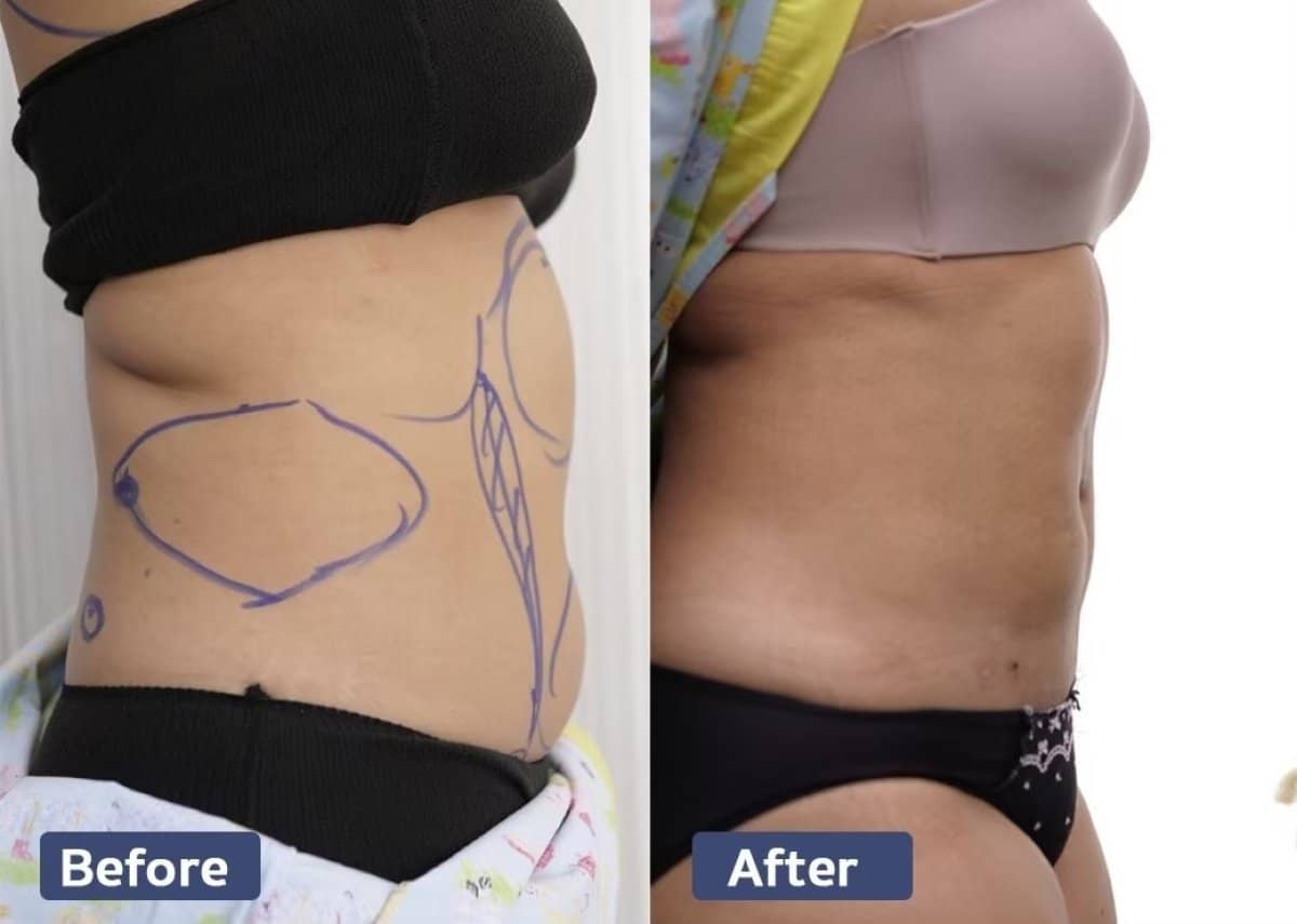 Case 20989 - liposuction