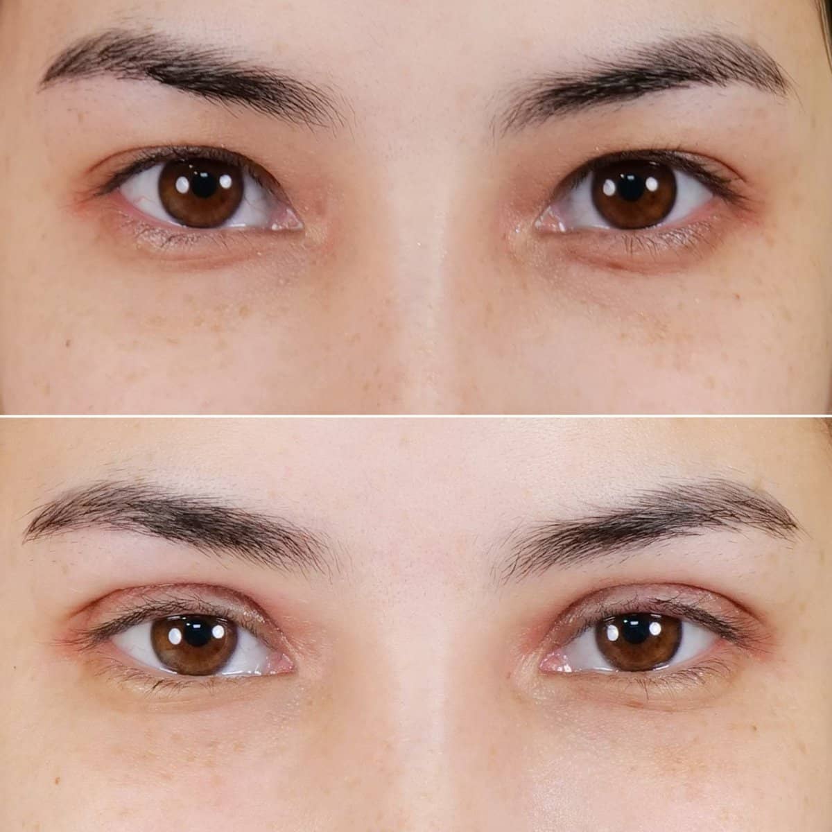 Case 20990 - double eyelid surgery