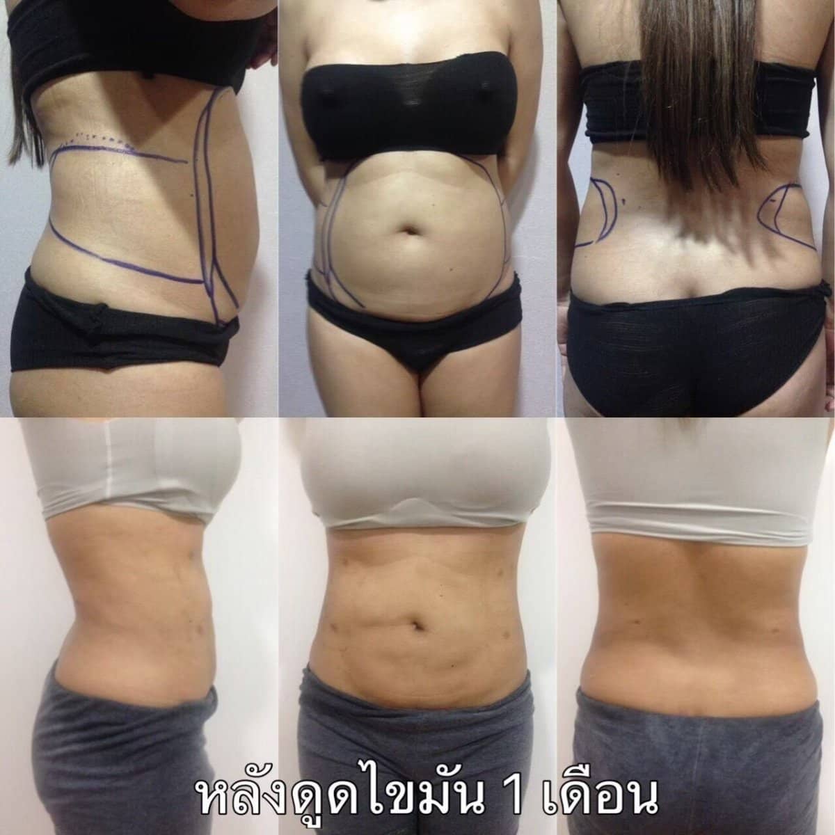Case 20991 - liposuction