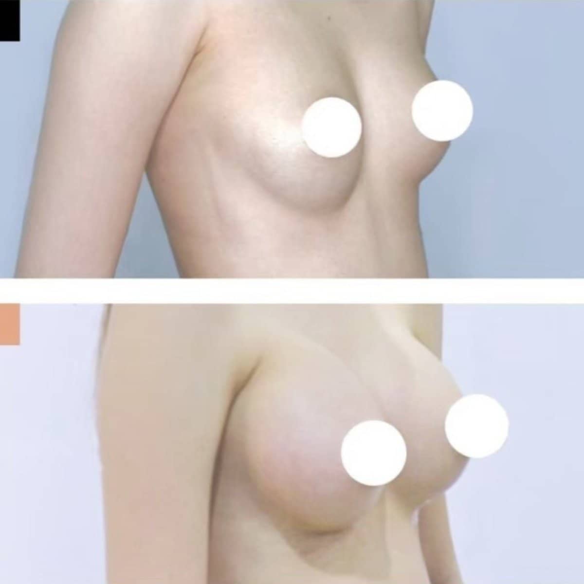Case 20992 - breast augmentation